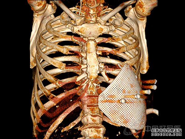西南医院利用医学“3D打印”技术为患者重建胸壁