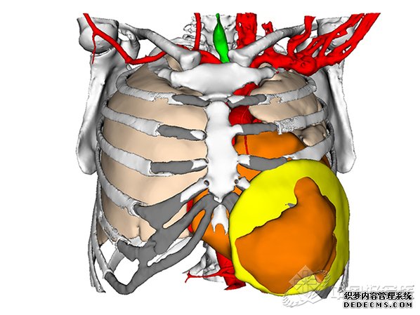 西南医院利用医学“3D打印”技术为患者重建胸壁