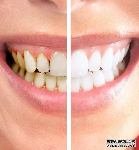 军医科普：牙齿颜色异常原因多 修复方法要选对