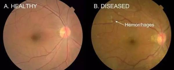 【j2开奖】谷歌研发人工智能眼科医生：用深度学习诊断预防失明