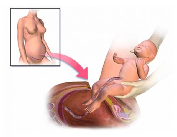 码报:【图】剖腹产会影响人类进化！大头宝宝越来越多了